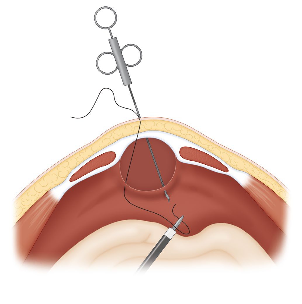 Port placement for laparoscopic orchidopexy