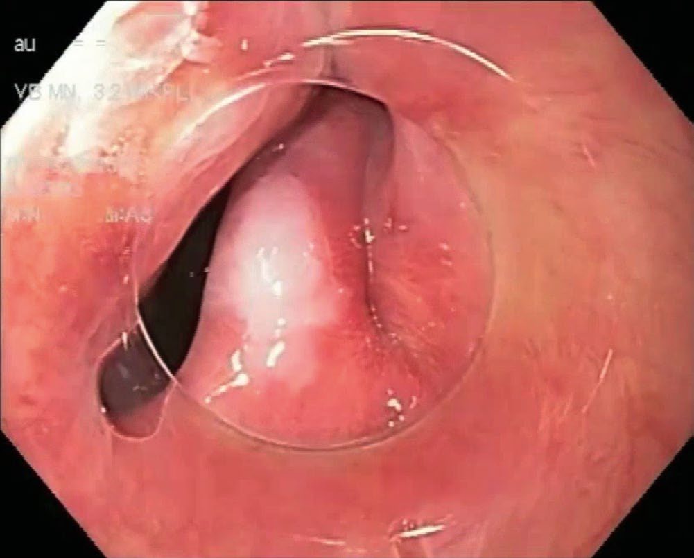 Endoscopic view of the muscular bar within the oesophagus creating a Zenker diverticulum