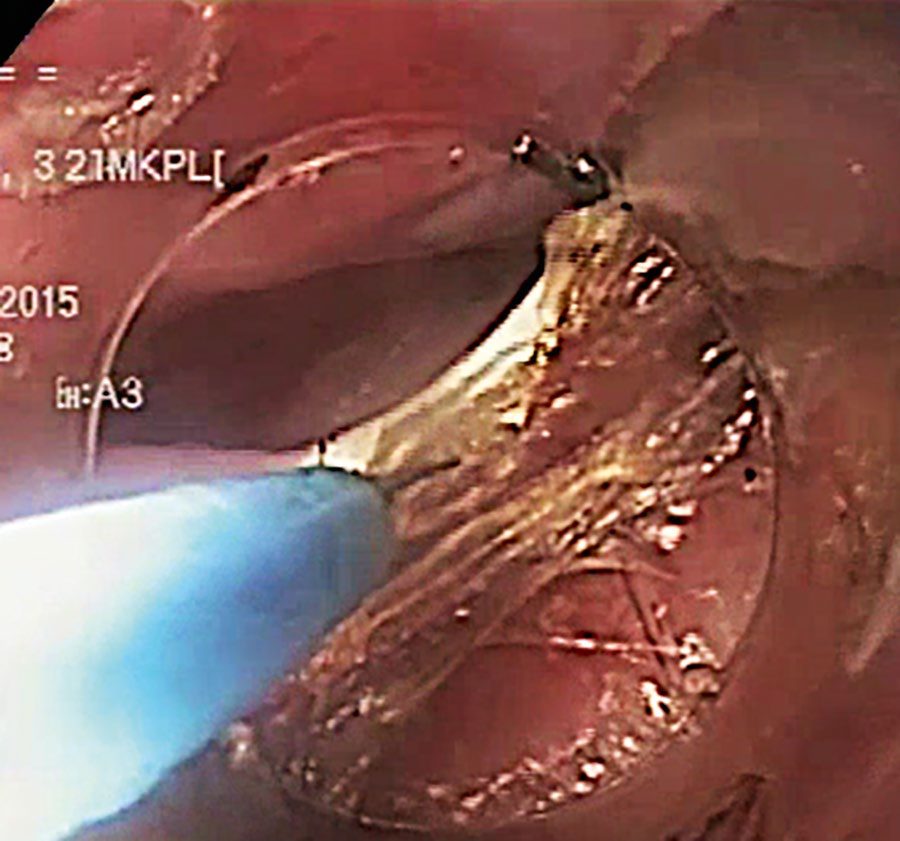 Myotomy of the cricopharyngeus muscle during Zenker per-oral endoscopic myotomy