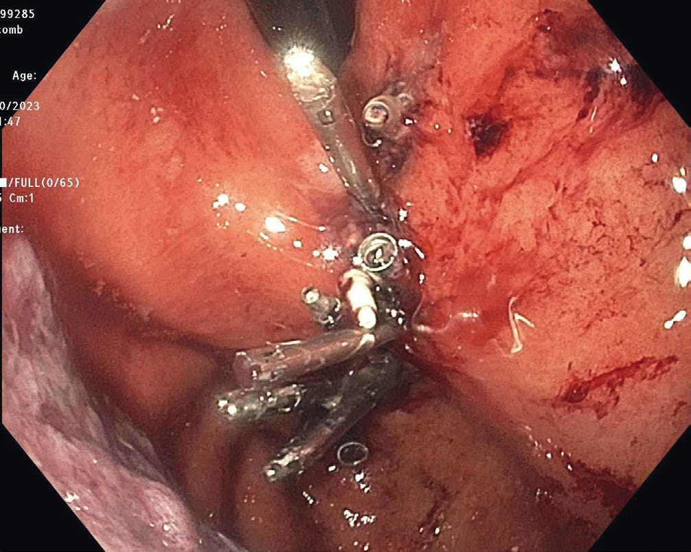 Gastric mucosotomy after submucosal injection during endoscopic submucosal dissection