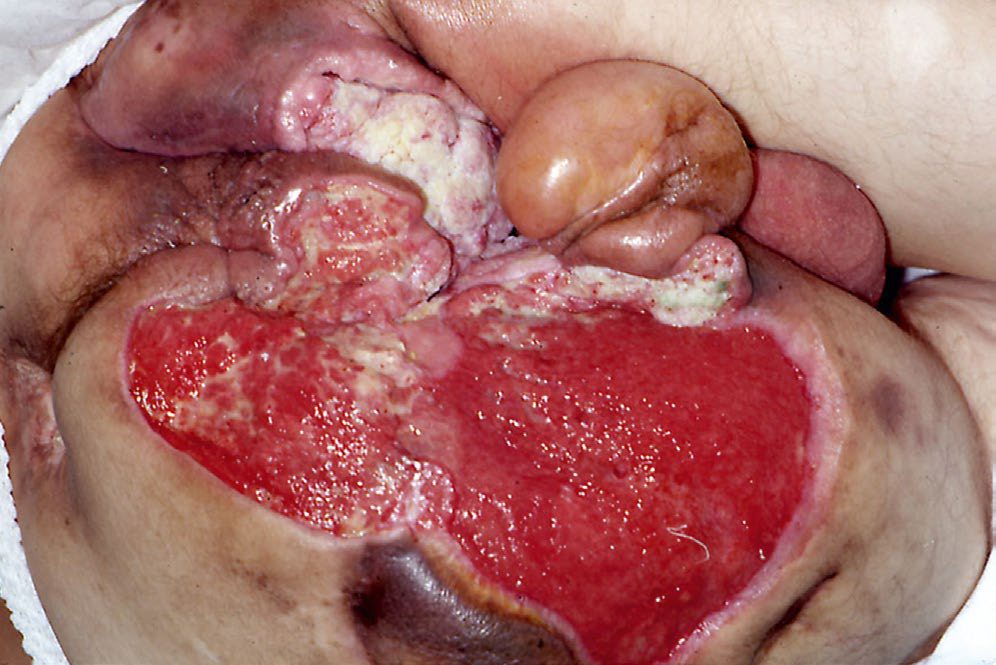 Squamous cell carcinoma arising in a chronic pressure sore