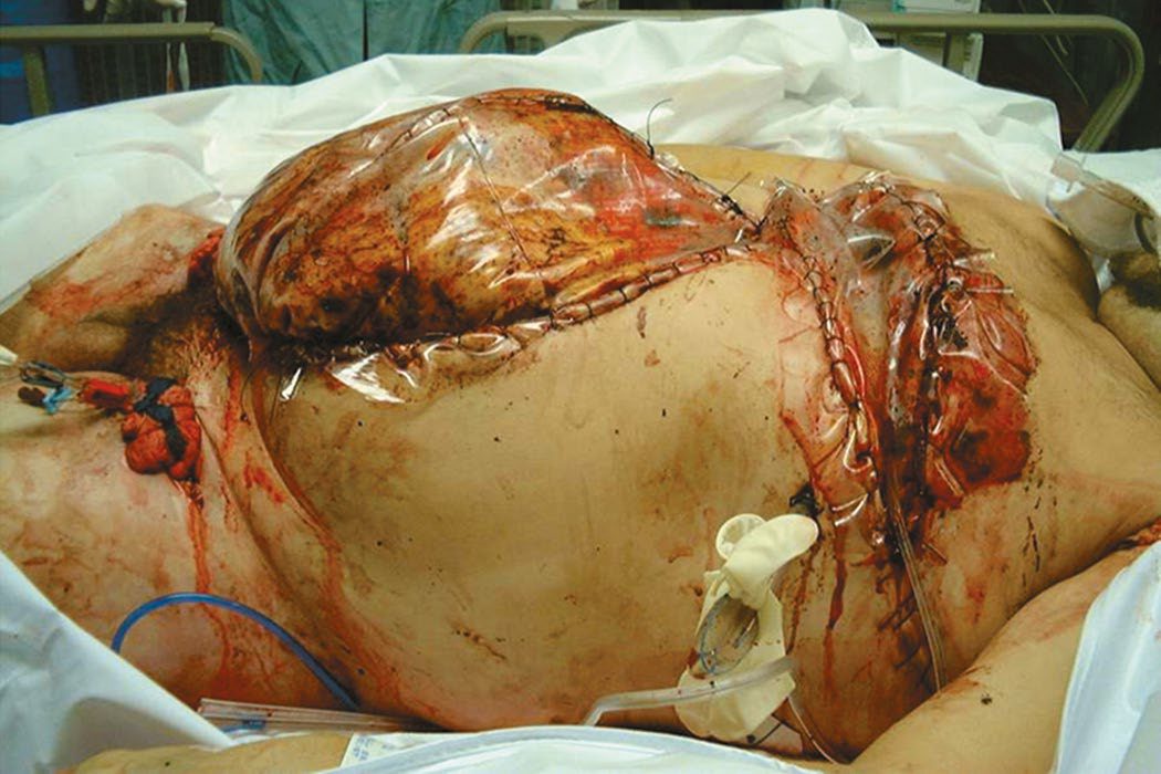 Patient after damage control surgery with abdominal and thoracic compartment syndrome caused by massive fluid resuscitation