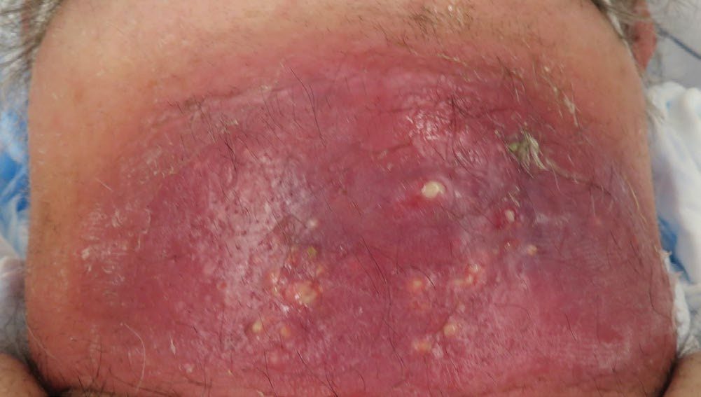 Carbuncle on the nape of the neck