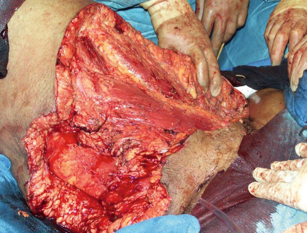 Surgical debridement of necrotizing soft tissue infection
