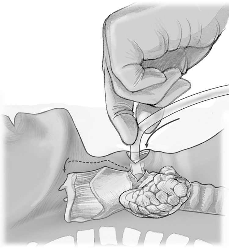 Technique of cricothyroidotomy: the cricothyroid membrane is identified by palpation, incised transversely, spread, and a tracheal tube passed