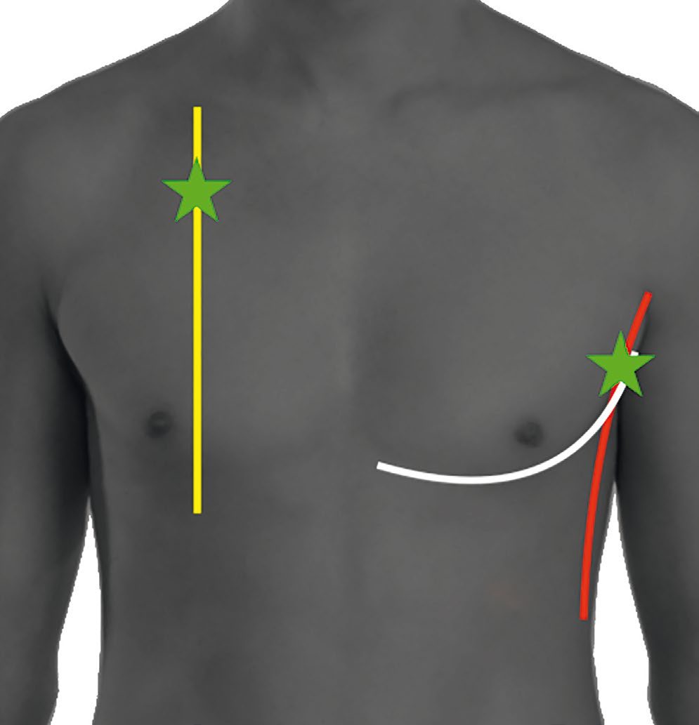 Locations for needle chest decompression; stars denote the approximate sites for emergent pleural decompression
