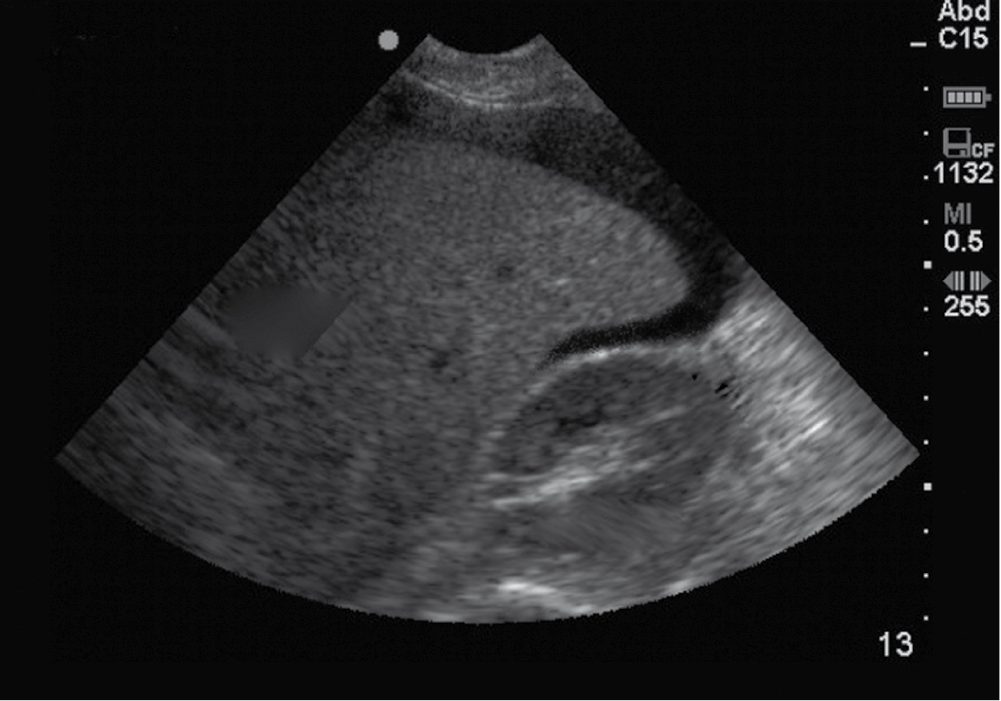 Focused assessment with sonography for trauma (FAST): fluid in the hepatorenal space (Morison pouch) between liver and right kidney, suggesting haemorrhage