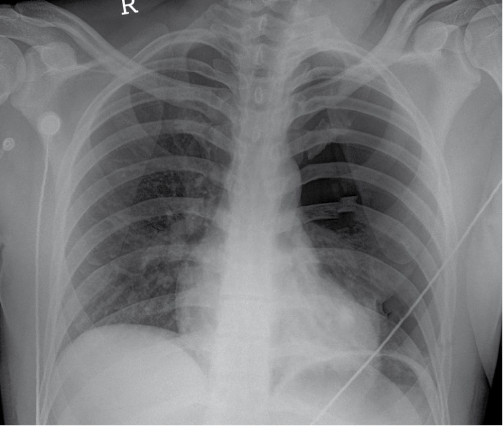 Large left-sided pneumothorax on chest radiograph