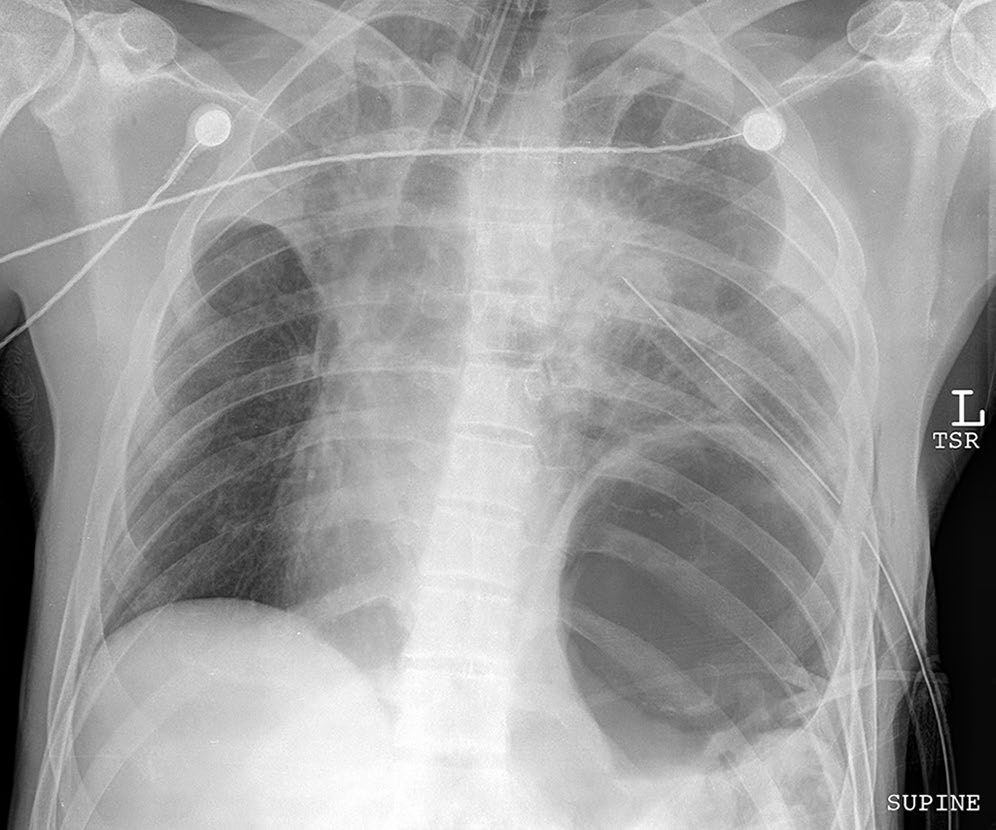 Left diaphragm injury on chest radiograph: the gas-filled stomach is visible in the left chest because of herniation through a large diaphragmatic laceration