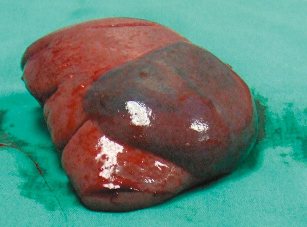 Splenic injury with subcapsular haematoma; despite only a 1-cm capsular tear this injury showed ongoing haemorrhage