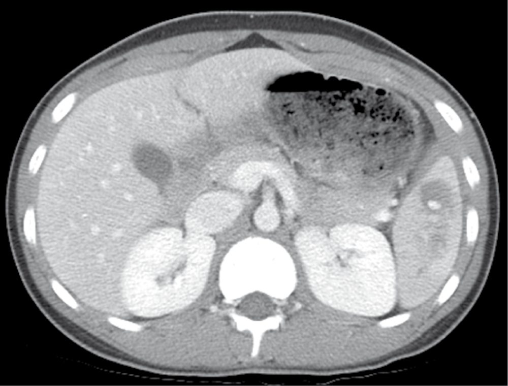 Grade III splenic laceration on abdominal CT, with a focus of active contrast extravasation