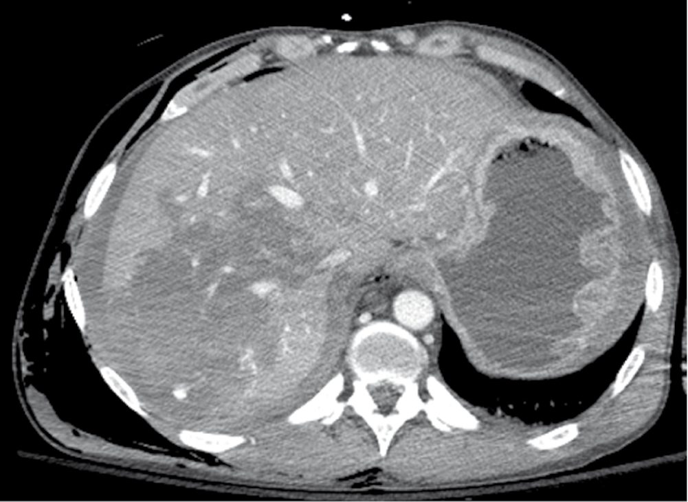 Grade IV liver laceration involving the right hepatic lobe on abdominal computed tomography, with active contrast extravasation in the injured parenchyma