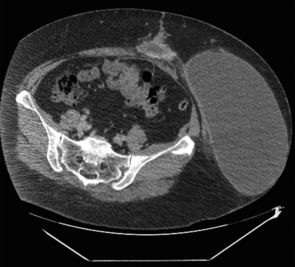 Seroma following skin flap creation