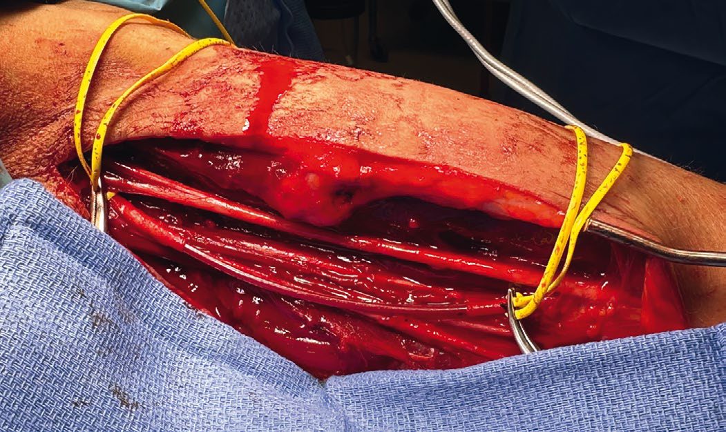 Brachial artery injury with a large missing segment from penetrating injury, managed with a temporary shunt