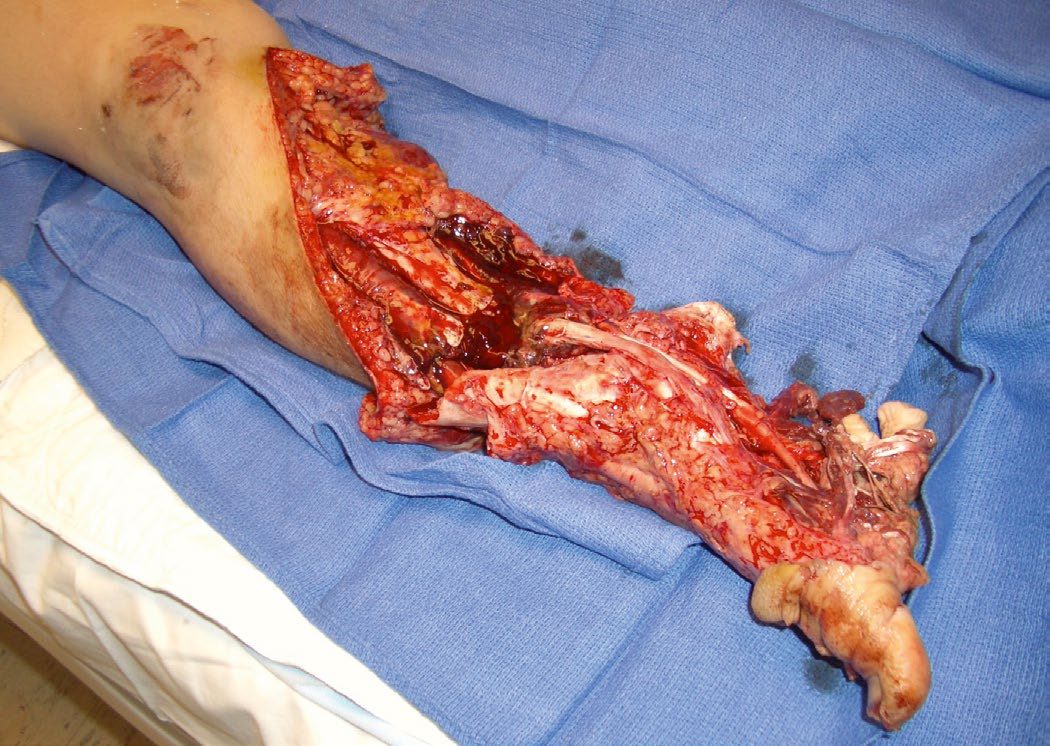Major disruption of tissues in a mangled extremity