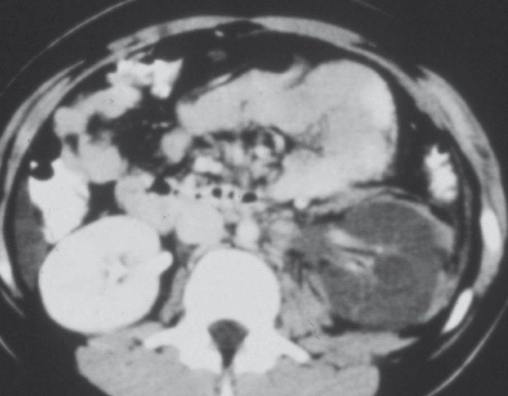 Grade I kidney injury on CT: left renal contusion