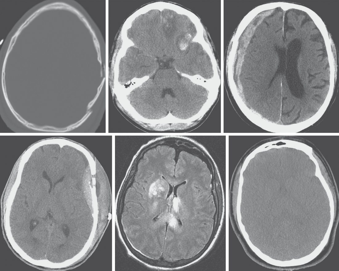 Typical radiographic findings in traumatic brain injury, including comminuted depressed skull fracture, contusions, subdural and epidural collections, and diffuse axonal injury on MRI
