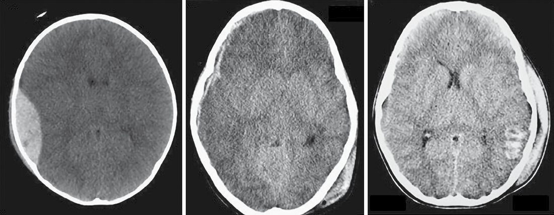 Computed tomography of the three main traumatic intracranial collections: (A) epidural haematoma, (B) subdural haematoma, (C) intraparenchymal haematoma