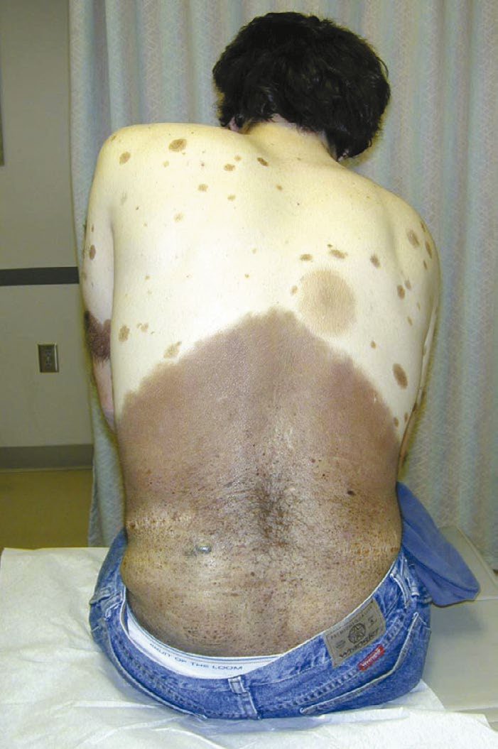 Giant congenital nevus of the trunk with an associated melanoma (arrow)