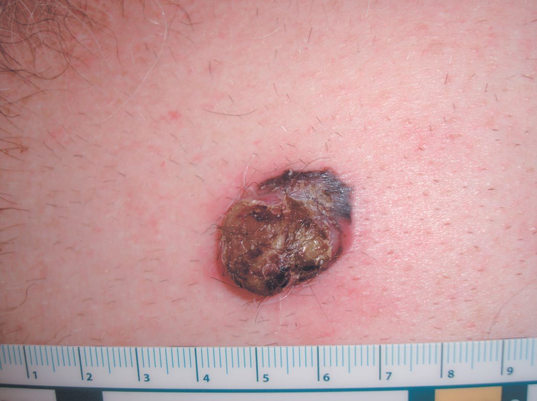 Nodular melanoma - the most aggressive subtype, with early vertical growth