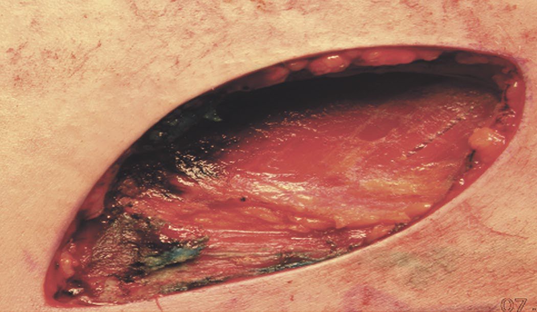 Fusiform incision allowing primary closure for wide local excision of melanoma, carried down to the muscular fascia