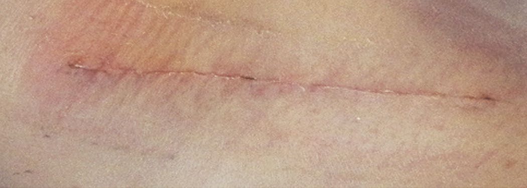 Fusiform incision allowing primary closure for wide local excision of a melanoma