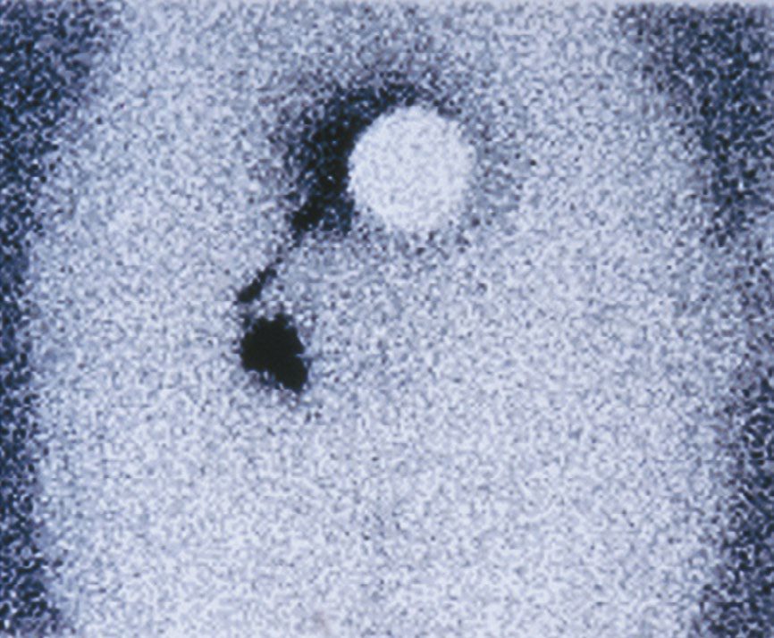 Preoperative lymphoscintigraphy aids identification of sentinel lymph nodes: melanoma of the back with drainage to the axilla