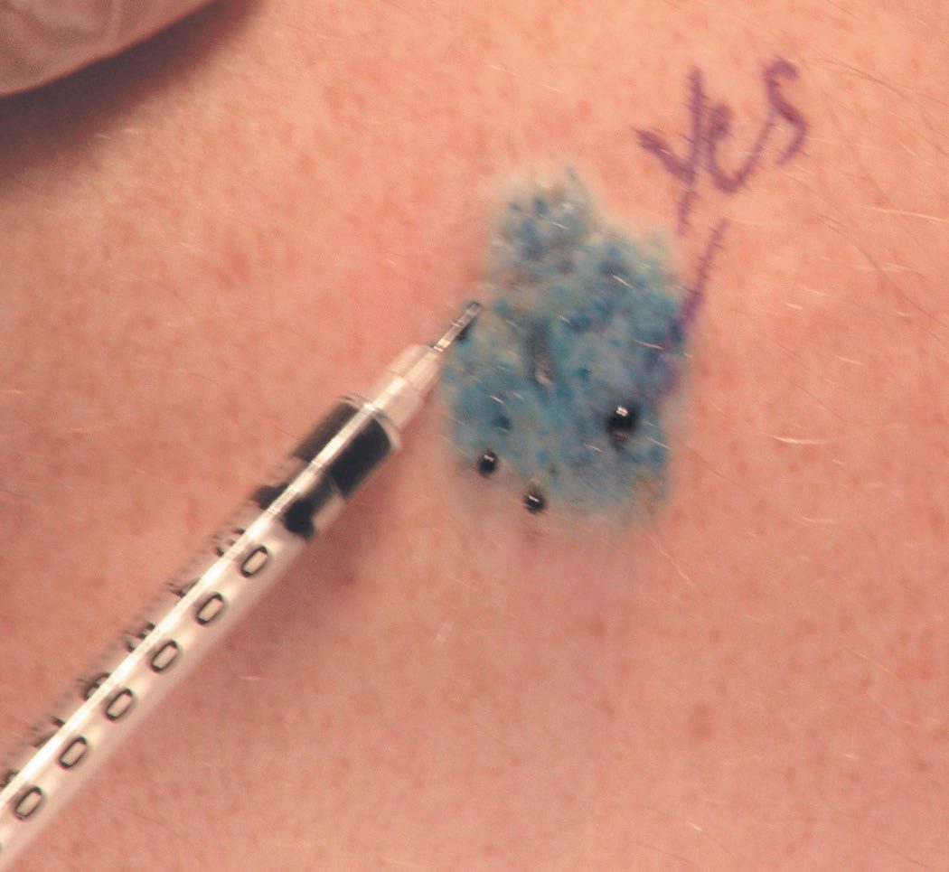 Intradermal injection of isosulfan blue dye for intraoperative lymphatic mapping and sentinel node biopsy