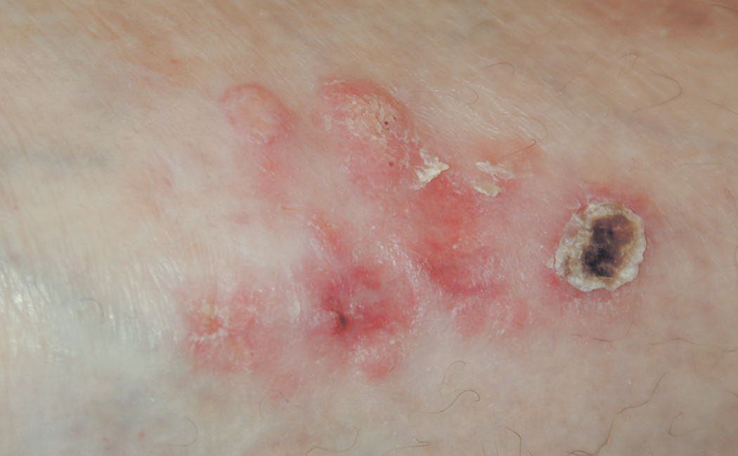 Squamous cell carcinoma with red, scaling skin