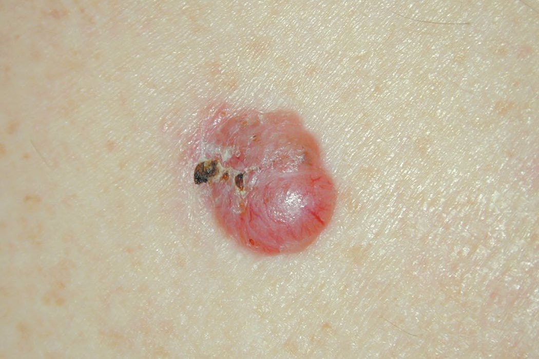 Nodular basal cell carcinoma