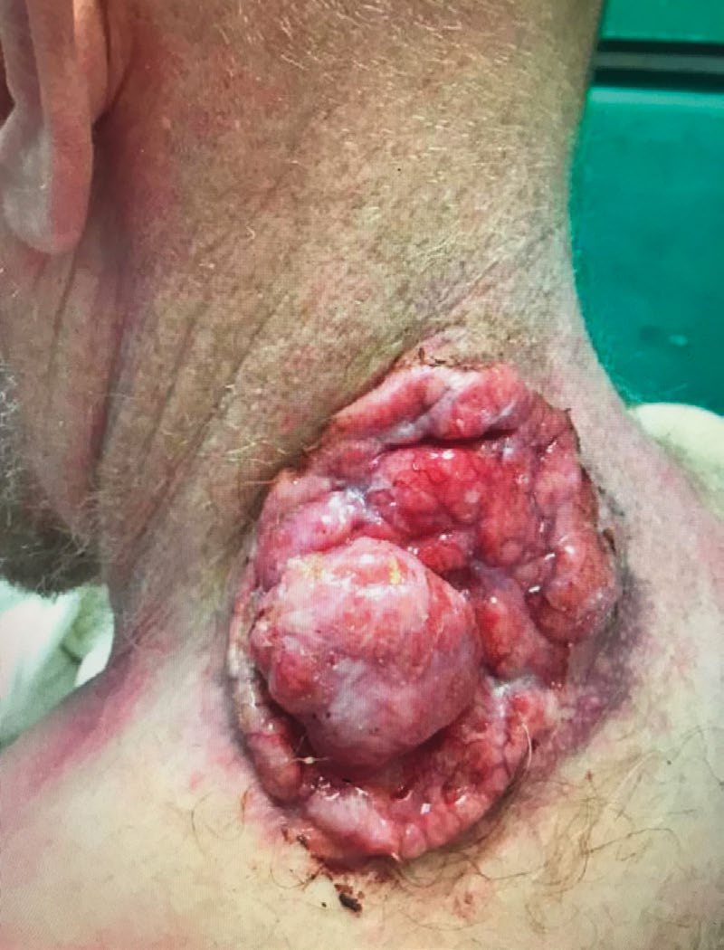 Locally advanced basal cell carcinoma