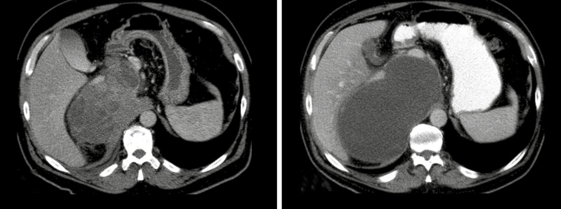 Liquefaction of a high-grade retroperitoneal sarcoma before (A) and after (B) 60-Gy preoperative radiation therapy; subsequent resection showed no viable tumour