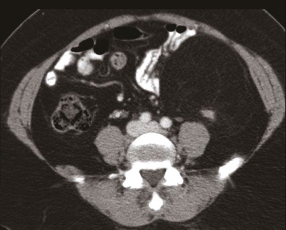 Computed tomography appearance of retroperitoneal liposarcoma, containing both well-differentiated and dedifferentiated elements