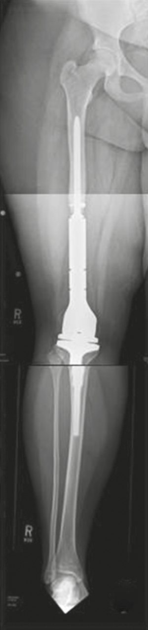 Limb-sparing reconstruction after resection of a periarticular bone tumour: distal femur endoprosthesis using press-fit fixation into the femoral canal