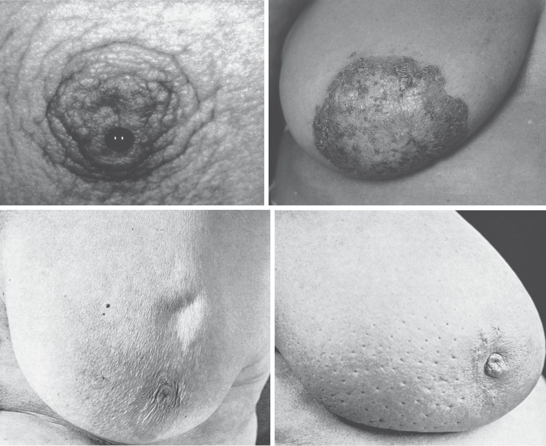 Common physical findings on breast examination: (A) single-duct nipple discharge, (B) Paget disease of the nipple, (C) skin dimpling from traction on Cooper ligaments, (D) peau d'orange