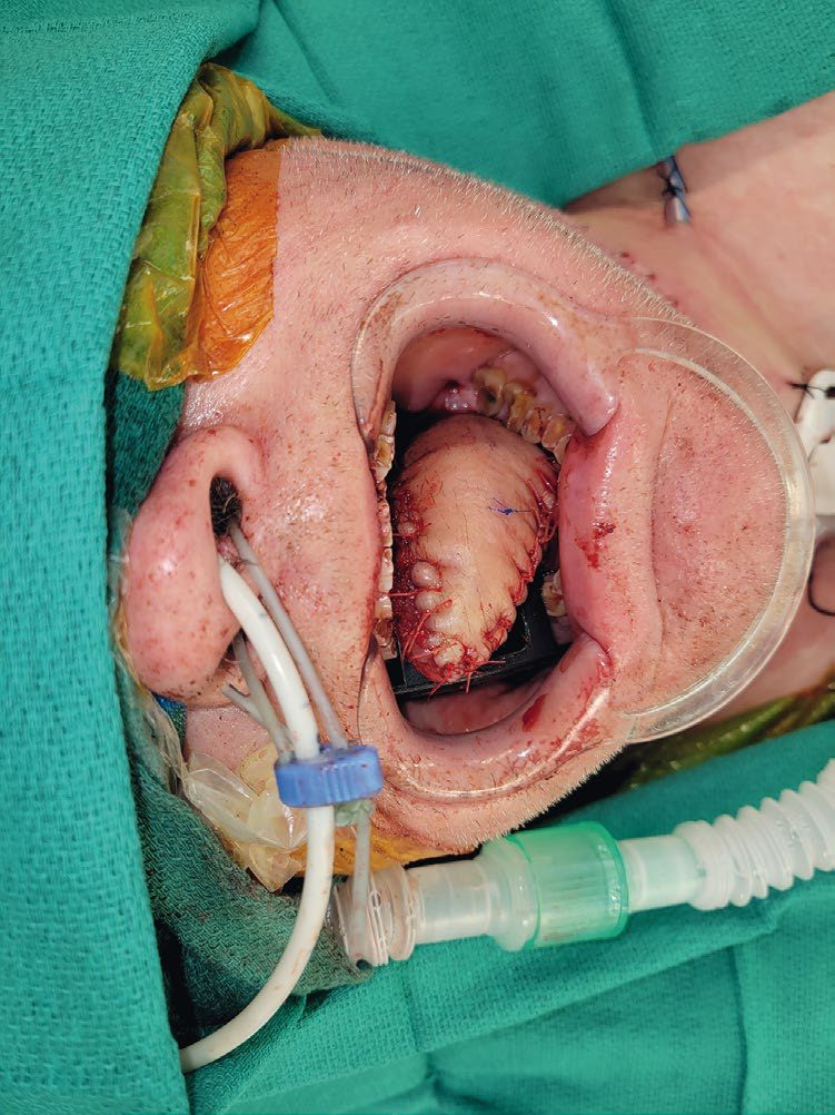 Ulcerative squamous cell carcinoma presenting to clinic