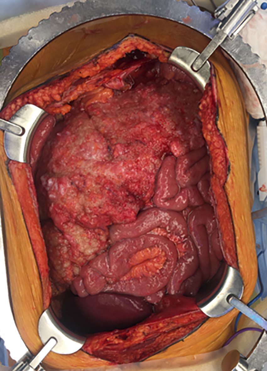 Omental cake obscuring evaluation of the peritoneal carcinomatosis index in low-grade appendiceal disease