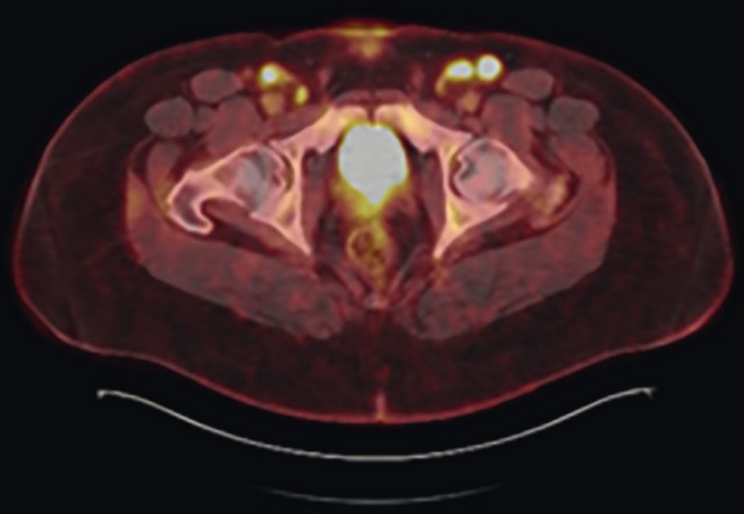 Positron emission tomography in new lymphadenopathy: hypermetabolic inguinal nodes (highest SUV) whose excisional biopsy revealed grade 3A follicular lymphoma