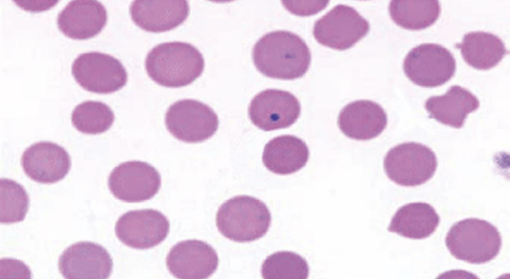 Howell-Jolly bodies (arrow) on a peripheral blood smear, the characteristic finding in asplenia or hyposplenism