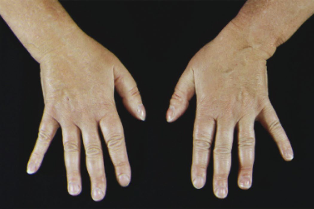 Thyroid acropachy, an extrathyroidal manifestation of Graves disease