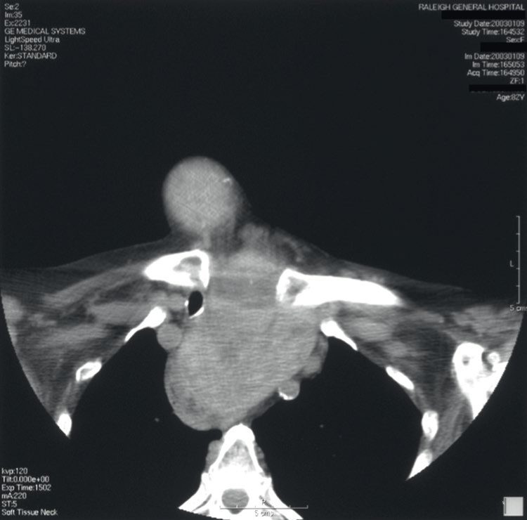 Computed tomography at the level of the thoracic inlet showing a large heterogeneous thyroid mass involving both lobes, displacing the trachea and extending into the anterior mediastinum