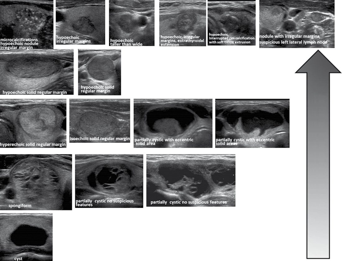 American Thyroid Association sonographic patterns for thyroid nodules and their associated risk of malignancy