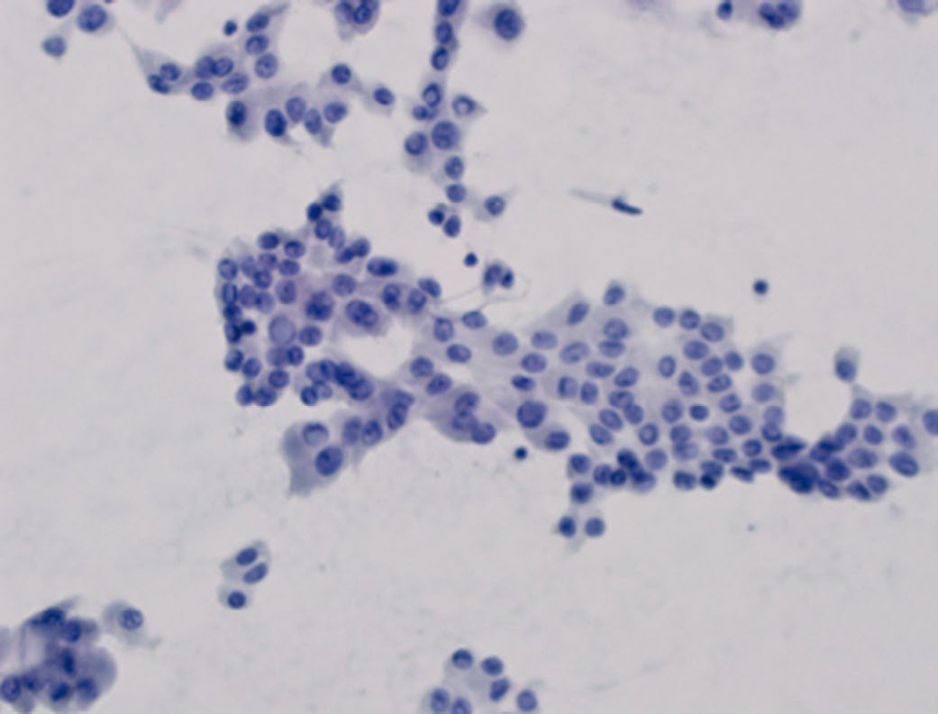 Representative cytological features of thyroid fine-needle aspiration specimens, arranged by Bethesda category