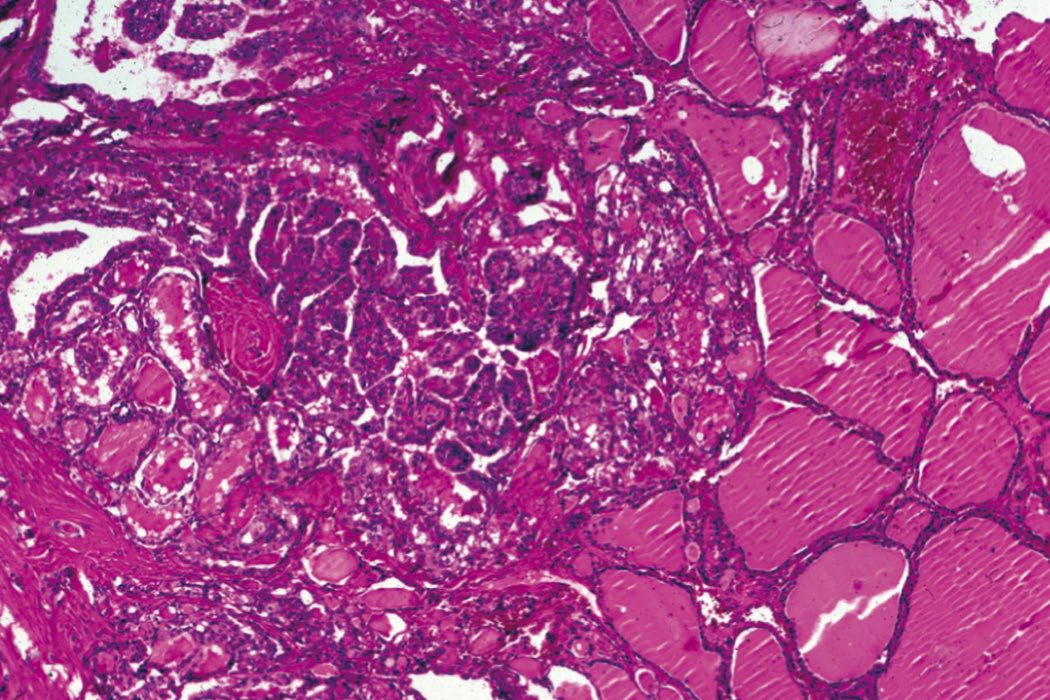 Haematoxylin and eosin staining of a thyroid mass revealing papillary projections consistent with papillary thyroid cancer