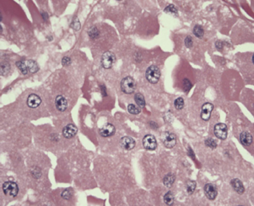 Haematoxylin and eosin staining of a follicular lesion of the thyroid