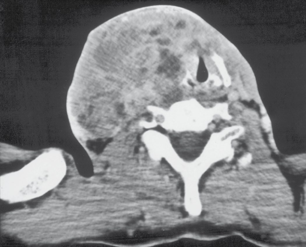 Rapidly enlarging thyroid mass in a patient in their seventies, with the corresponding computed tomography