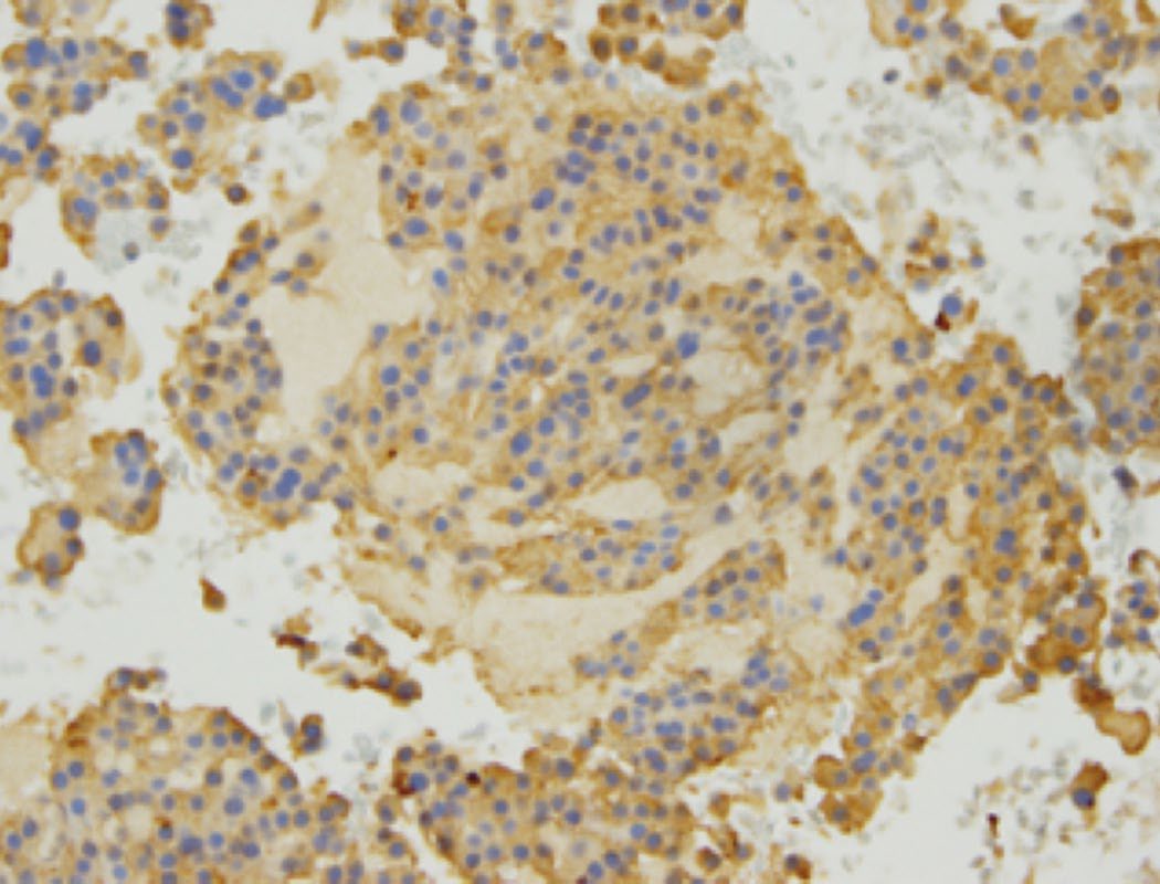 Medullary thyroid cancer exhibiting cytoplasmic positivity on calcitonin immunostaining