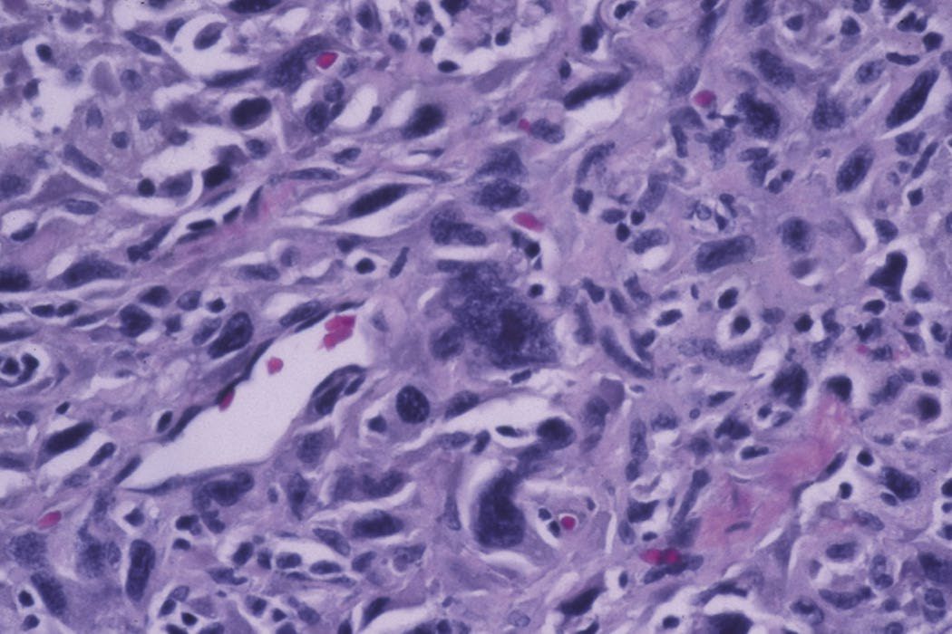 Anaplastic thyroid cancer: haematoxylin and eosin staining showing marked nuclear pleomorphism, oval to spindle-shaped cells and a multinucleated tumour cell
