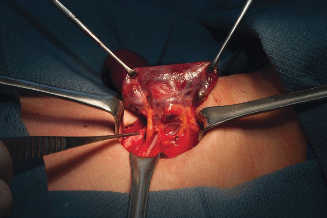 Intraoperative photograph showing normal left superior and inferior parathyroid glands