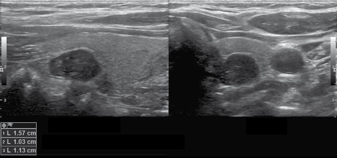 High-resolution ultrasound in longitudinal and axial views showing a hypoechoic mass posterior to the superior pole of the left thyroid lobe, a left superior parathyroid adenoma